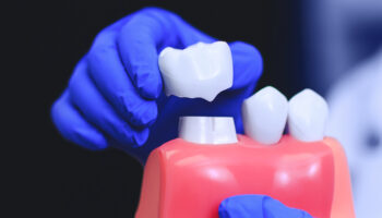 Smile Protection: The Power of Dental Crowns for Lasting Health