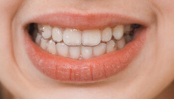 Can You Straighten Your Teeth Without Braces?