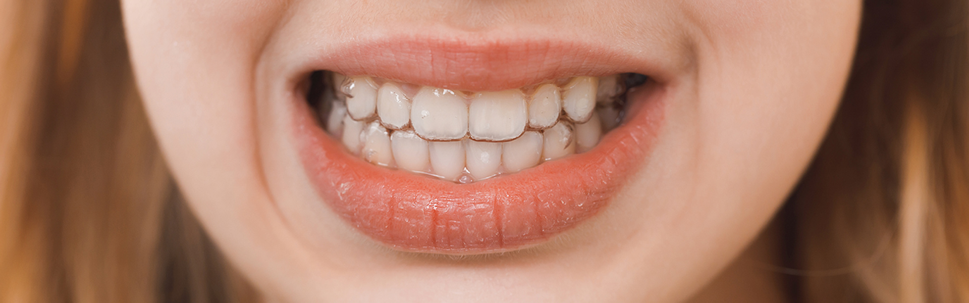Can You Straighten Your Teeth Without Braces?