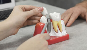 What Is a Dental Implant Abutment and Why Is It Important?