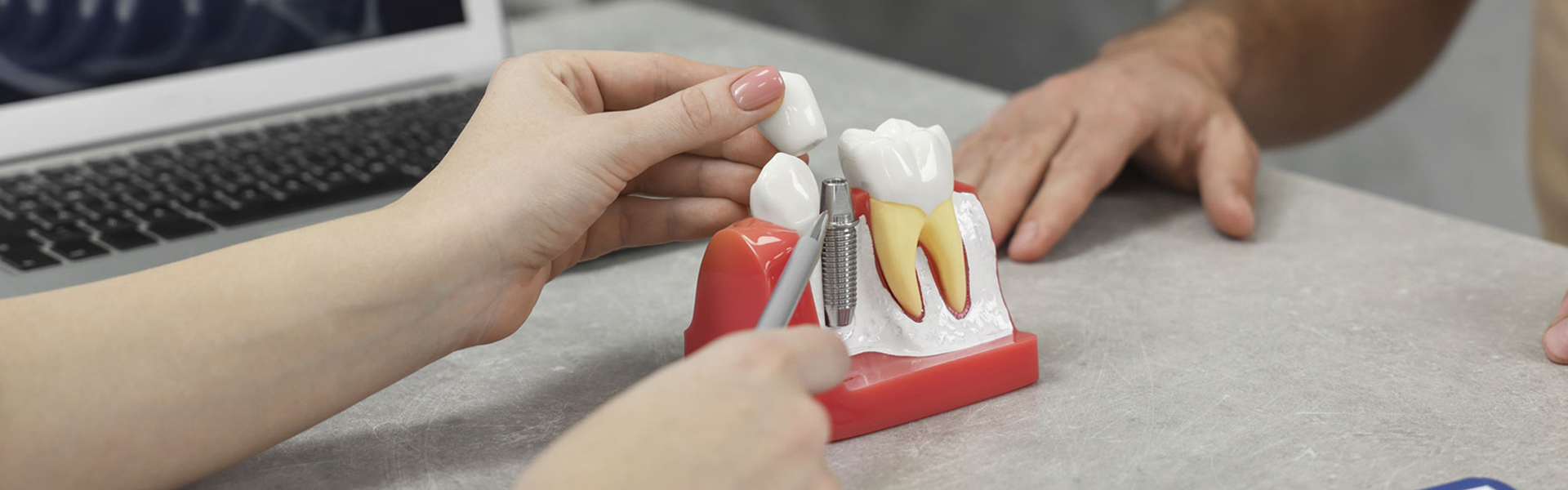 What Is a Dental Implant Abutment and Why Is It Important?